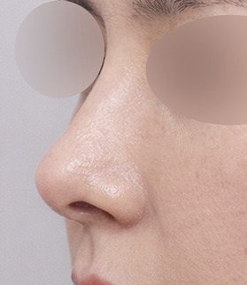 코재수술 콧대 코끝 흉살 제거+코끝진피 수술 후