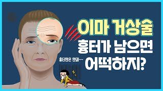 유튜브 썸네일 — 이마거상술 후 흉터는 어느정도?