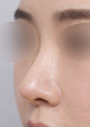 코재수술 수술 후