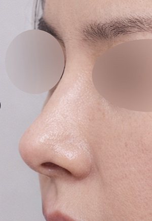 코재수술 수술 후