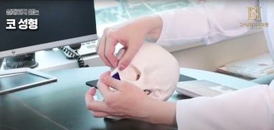유튜브 썸네일 — 변형과 유착 원인까지 분석, 코보형물 제거